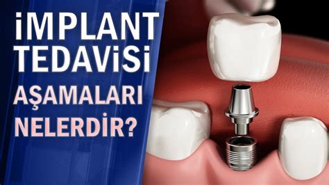 İmplant Aşamaları: Hazırlık, Yerleştirme ve Bakım