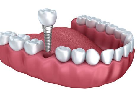 İmplant Nedir? Diş Sağlığında Yeni Dönem