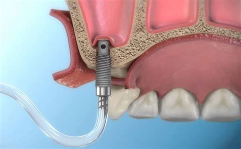 Sinüs Lift Ameliyatı: İmplant Üzerindeki Etkileri ve Önemi