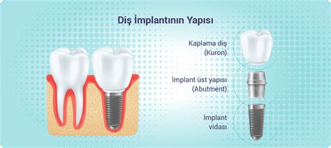 İmplant Çeşitleri