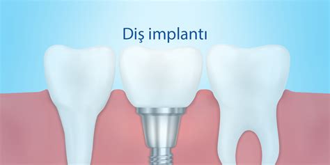 İmplant Çeşitleri