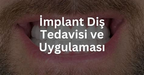 İmplant İnovatif Gelişmeler