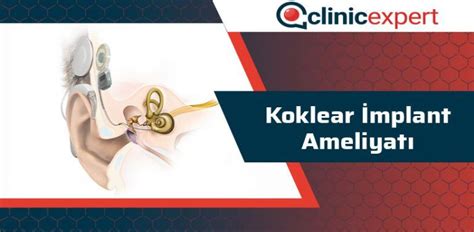 Koklear İmplant